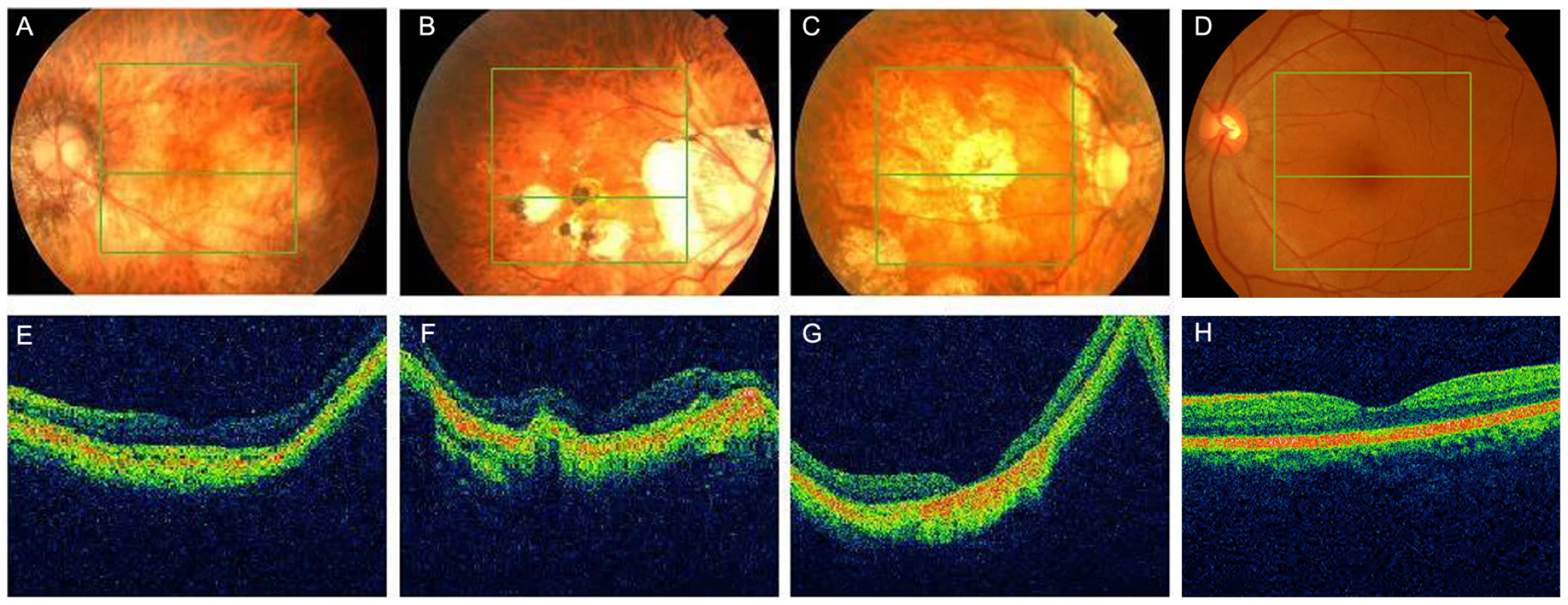 Fundus photographs and optical coherence tomography (OCT) of high myopia patients from the sporadic cases.