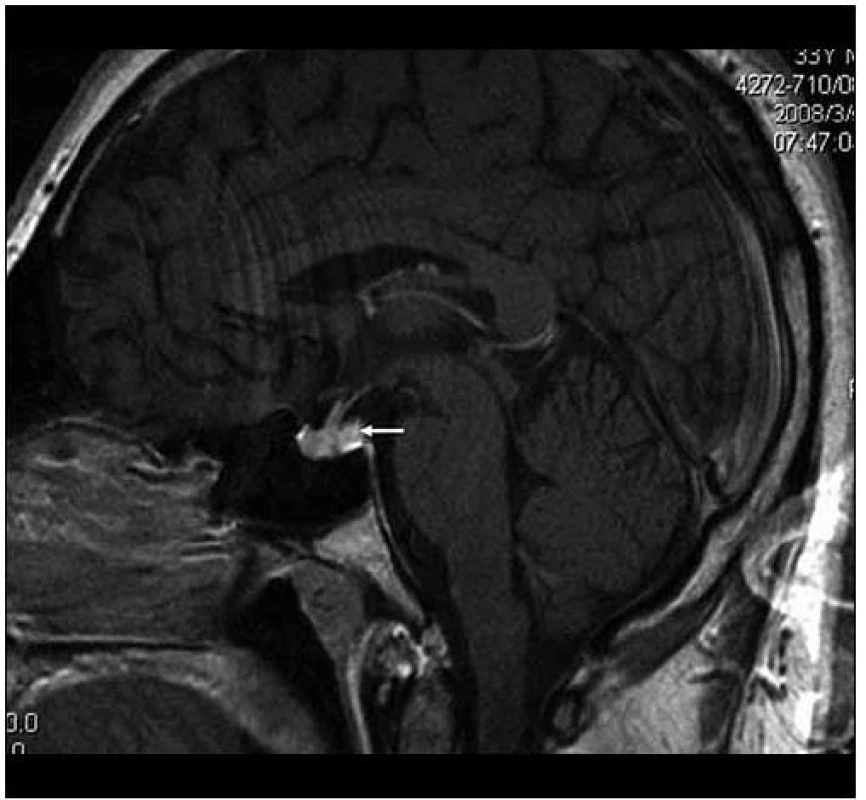 MR vyšetření, T1 vážený obraz ukazuje sagitální rovinu téhož vyšetření. Je patrný rovněž normální vzhled
stopky, chybí však normální hypersignální tkáň neurohypofýzy, na jejím místě je nejasný ložiskový infiltrát.
