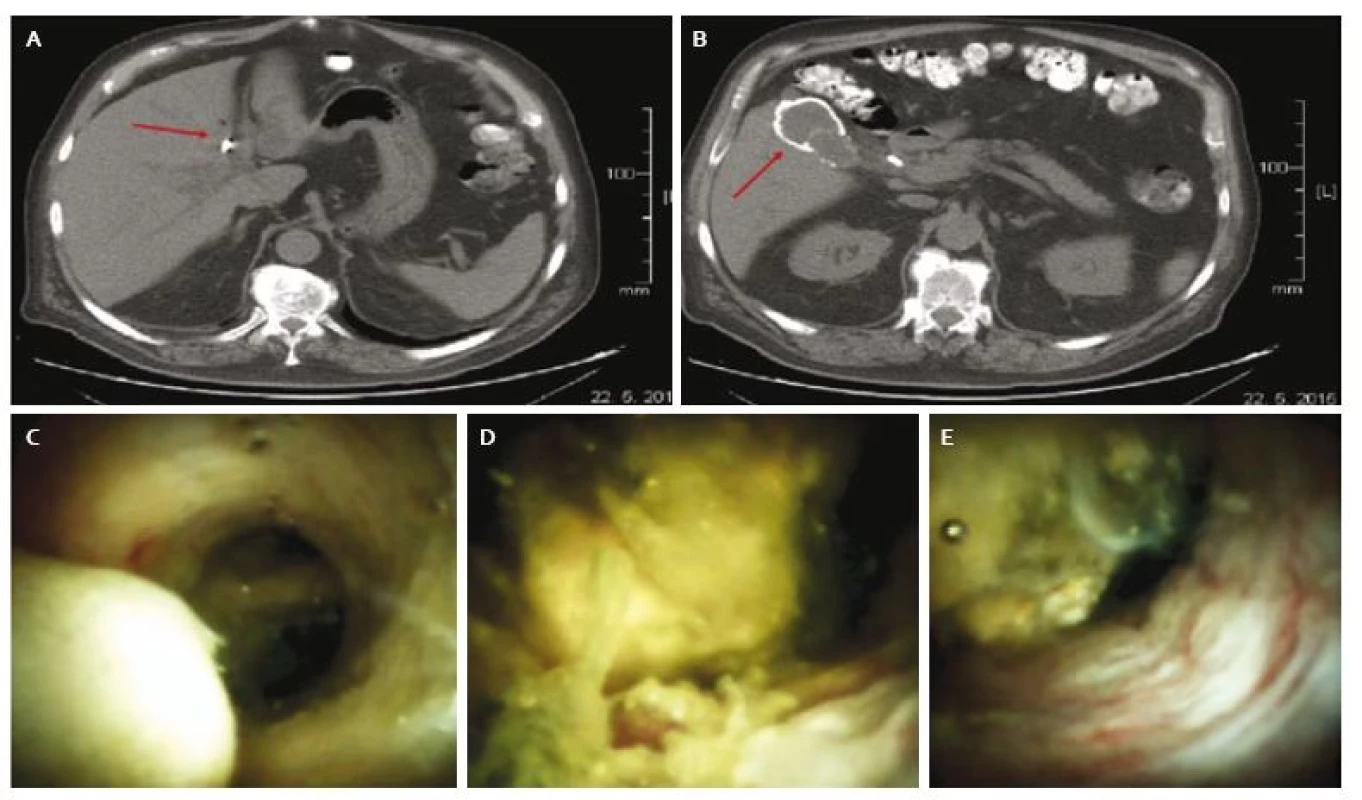 A. CT obraz suspektnej tumoróznej lézie v oblasti hílu pečene, B. porcelánová cholecysta (šipka), C. cholangioskopický obraz normálnej sliznice v junkcii s malým konkrementom, v pozadí sekundárne vetvy ľavého hepatiku, D. odliatkový konkrement v oblasti junkcie, E. zápalovo zmenená sliznica v oblasti spoločného hepatiku.
Fig. 1. A. CT image of suspected tumorous lesion in the hilar region of the liver (arrow), B. porcelain gallbladder (arrow), C. cholangioscopic view of normal mucosa at hepatic junction with a small bile duct stone, left intrahepatic bile ducts are visible in the background, D. bile duct stone in the hilar region, E. inflamed mucosa of common hepatic duct.