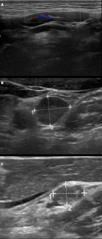 Ultrazvukový obraz lymfatické uzliny benigního (A), neurčitého (B) a maligního (C) charakteru