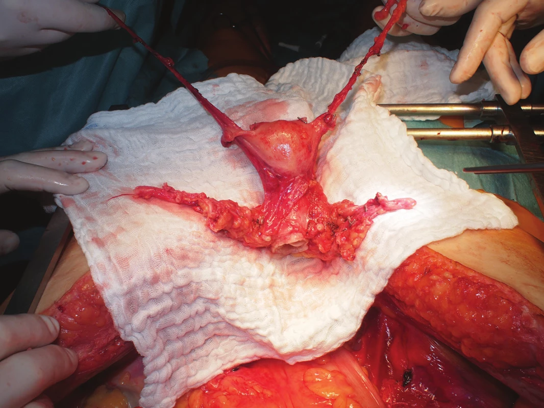 Uterus graft from a deceased donor after in-situ cold perfusion following graft excision