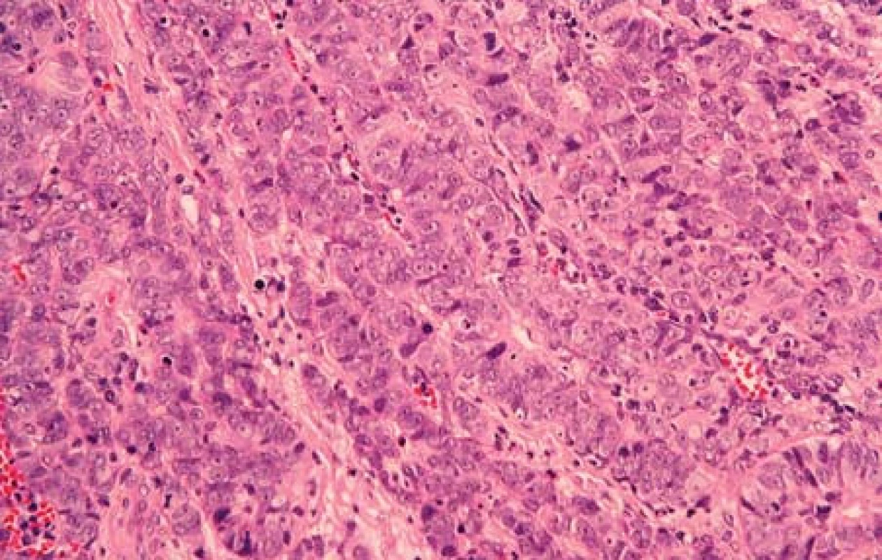 Trabekulární uspořádání nádorových buněk velkobuněčného NEC G3 (případ č. 2) (HE, 400x).