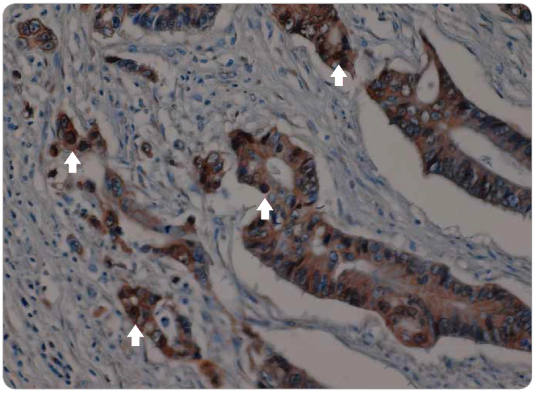 Zvýšená jaderná exprese (translokace) β-cateninu v nádorové tkáni kolorektálního karcinomu periferní části tumoru (šipky).