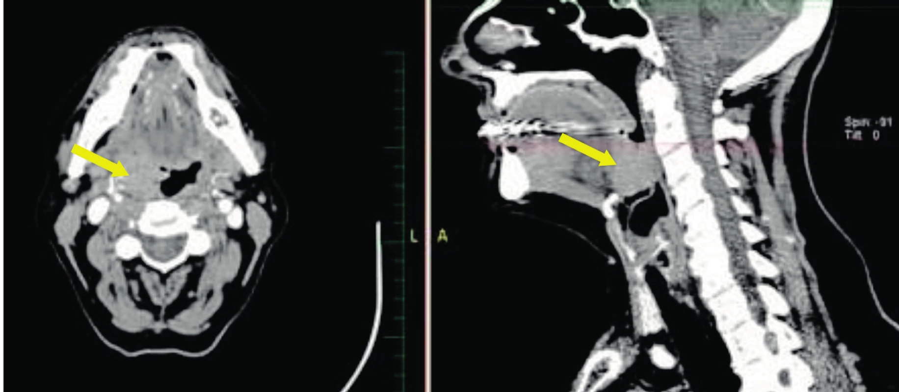 CT snímky s kontrastem - šipka ukazuje na karcinom tonzily stadia T2 vrůstající do kořene jazyka vhodného pro TORS.
