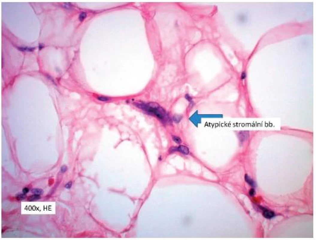 Atypické stromální buňky
Fig. 5. Atypical stromal cells