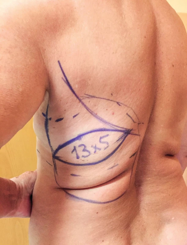 Latissimus dorsi flap planning. The bra strap area is marked first when the patient is wearing her bra. The horizontal or slightly transverse skin paddle is localized in the middle of the bra strap area