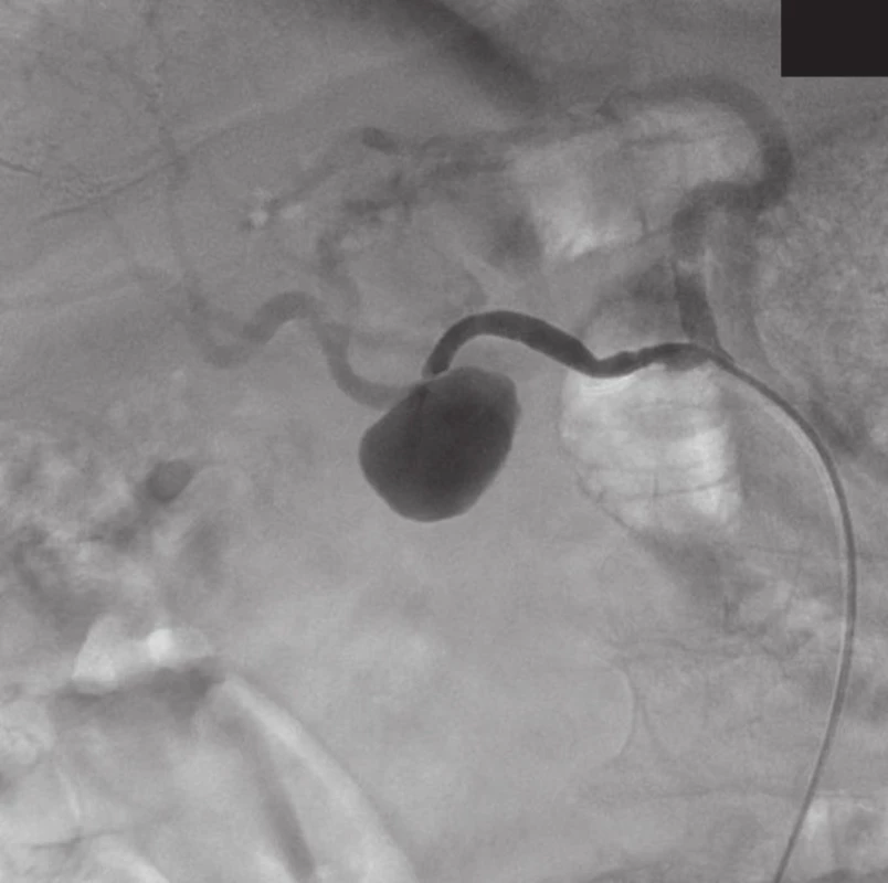 AG nález pseudoaneuryzmatu a. hepatica 
Fig. 2: Angiographic finding of pseudoaneurysm of hepatic artery