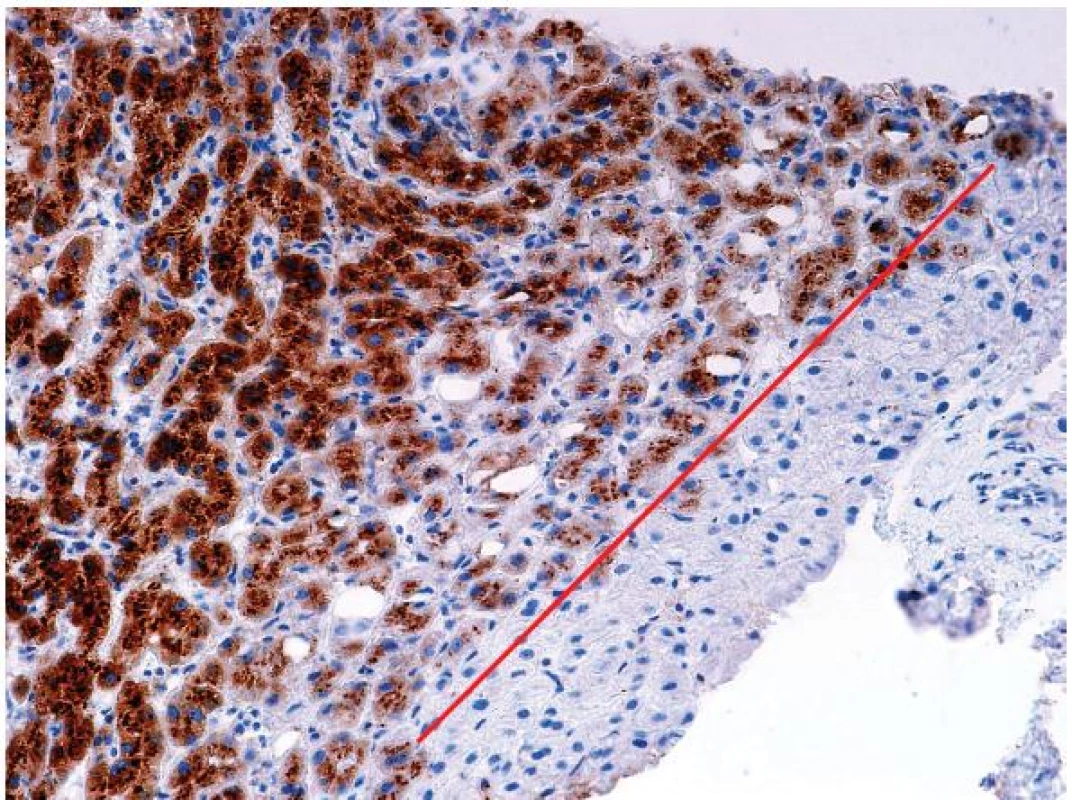 Imunohistochemický průkaz (SAA) s cytoplazmatickou pozitivitou v buňkách I-HCA, s ostrou hranicí negativního průkazu (červeně) v okrsku nenádorové tkáně v okraji vzorku (SAA, objektiv 20x).