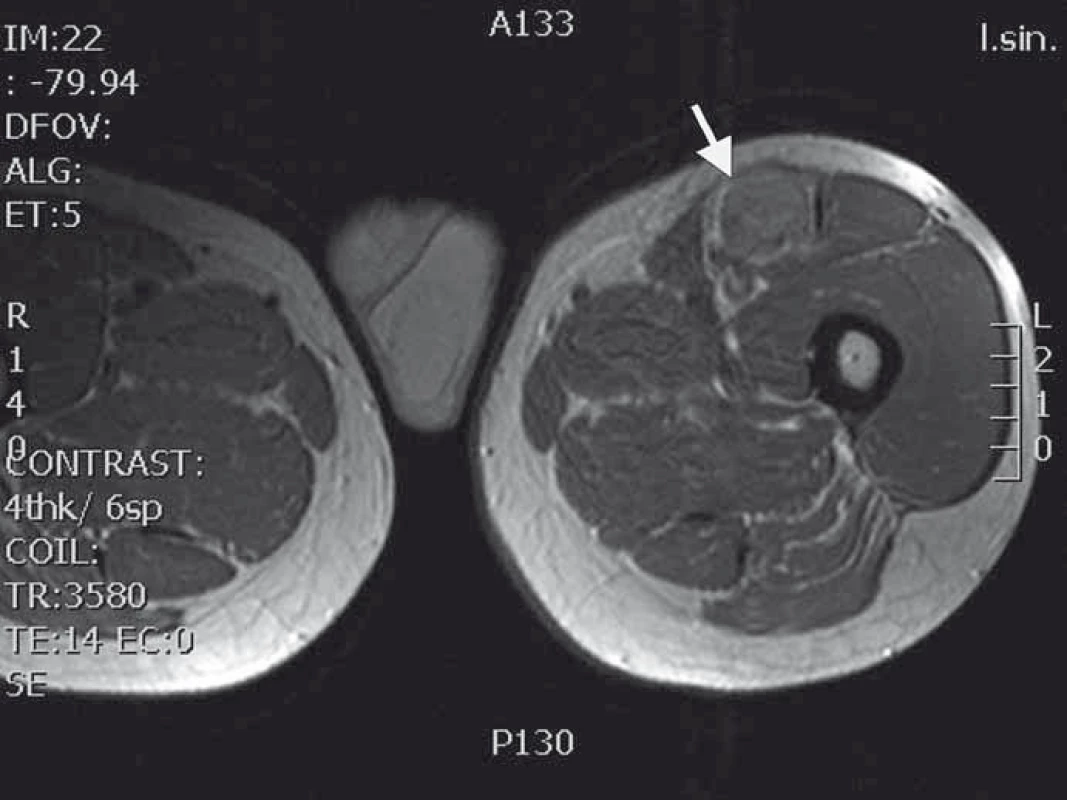 MRI T1 vážený obraz nádoru nasedajícího na levý n. femoralis několik centimetrů po jeho výstupu zpod tříselného vazu.