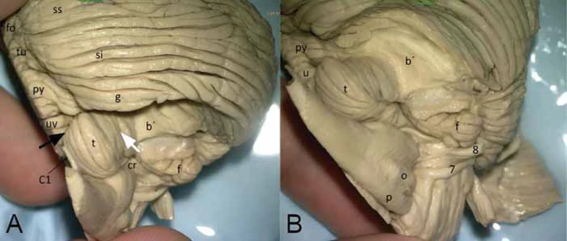 Pohled na tonsillu cerebelli zezadu (A) a zespodu (B) po odstranění lobulus biventer.