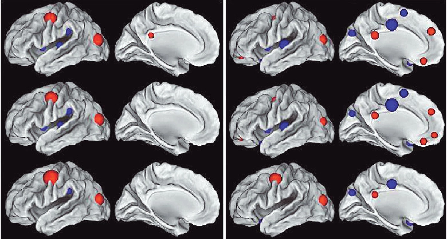 Oblasti statisticky významných rozdílů mezi ženskými a mužskými mozky zjištěná topologickou analýzou – muži: levý panel, ženy: pravý panel. Velikost uzlů (červené a modré kruhy) znázorňuje skóre nesouměrnosti měřené třemi veličinami (v obou panelech řady shora dolů) jimiž jsou stupeň, výkonnost a vzájemnost. Červená barva označuje pravostrannou asymetrii (pravá strana &gt; než levá), modrá barva označuje levostrannou asymetrii (levá strana &gt; než pravá). Mezi funkčními systémy ženských a mužských mozků existují jak stejnostranné, tak stranové rozdíly (45).