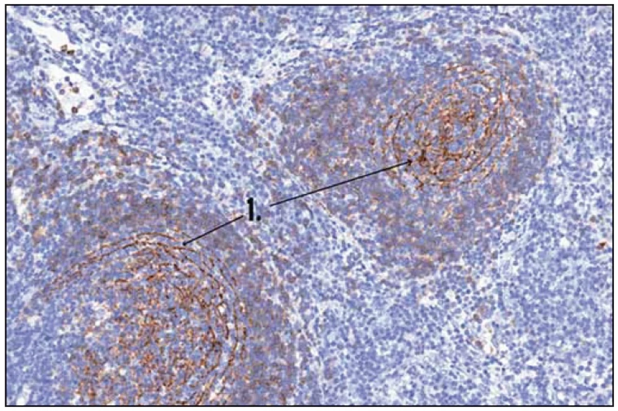Histologický obraz Castlemanovy nemoci. 1 – CD 23 (FCRII) – folikulární dendritické buňky.