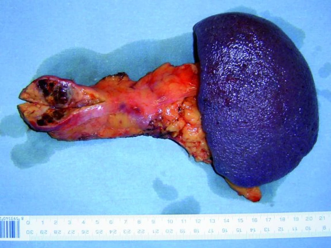 Resekát pankreatu s metasázou karcinomu ledviny.