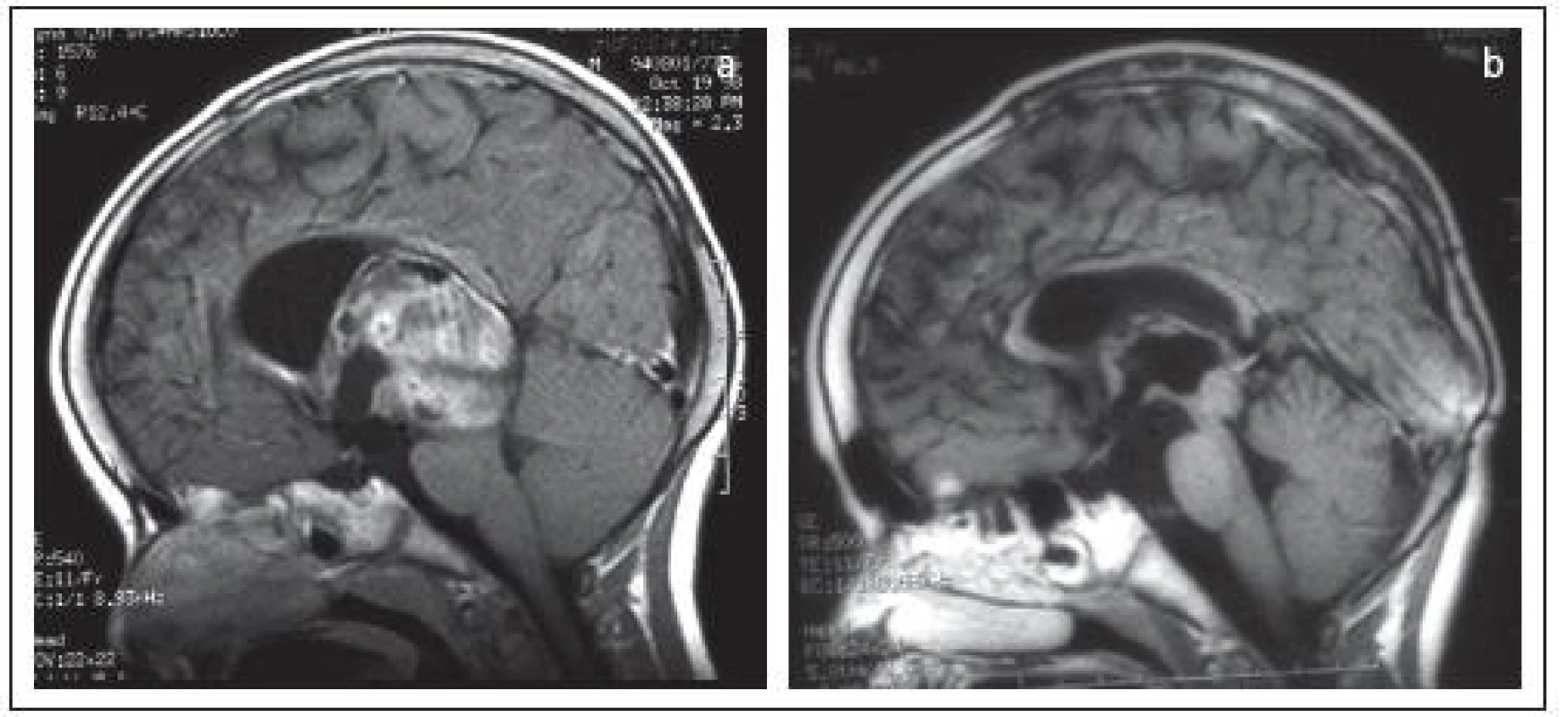 Subependymóm zadnej časti tretej mozgovej komory u 4-ročného chlapčeka (a) radikálne odstránený z transtentoriálneho prístupu (b).
