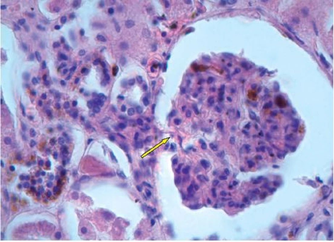 Ledvinný glomerulus s hnědými depozity hemosiderinu, hematoxylin-eosin