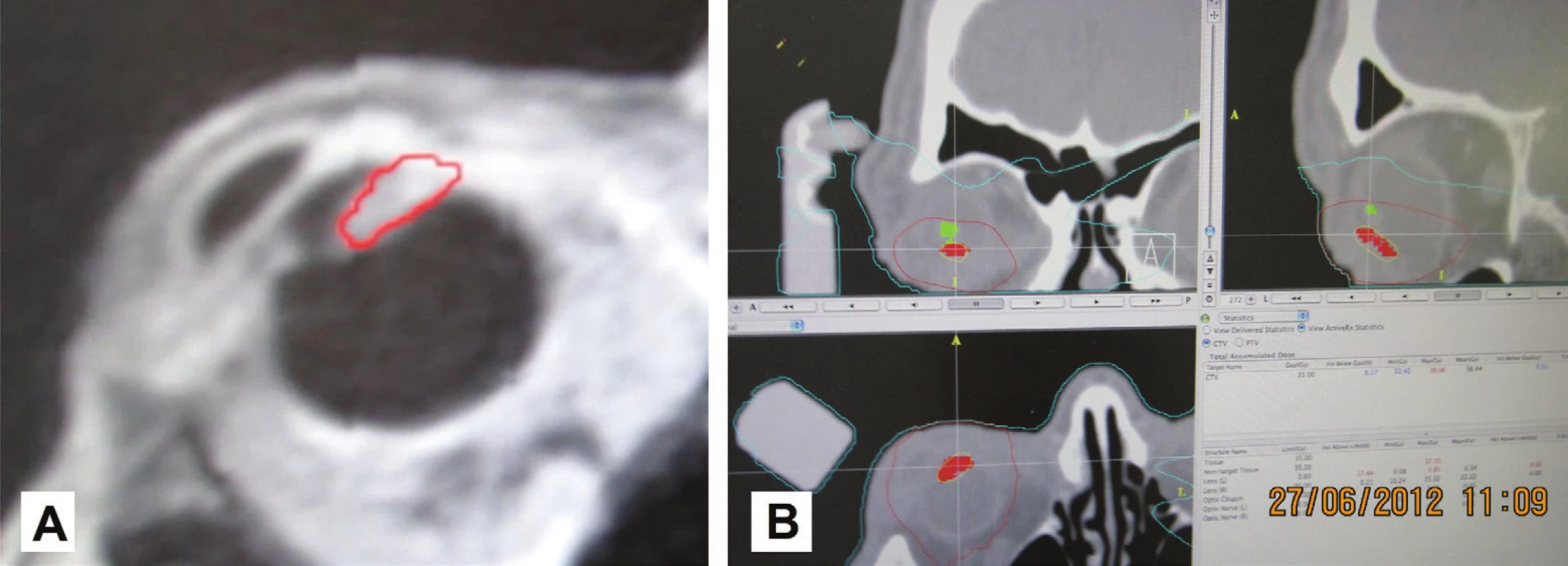 MRI obraz pacienta so zakresleným tumorom v oblasti corpus ciliare s prerastaním smerom „dopredu“ a do komorového uhla (A) a zakreslenie tumoru corpus ciliare (červená farba) a šošovky (zelená farba) v plánovacej schéme rádiochirurgického ožiarenia na lineárnom urýchľovači (B)