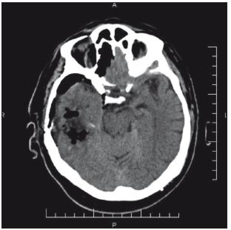 CT mozku: příznivý nález po evakuaci hematomu z kraniotomie.