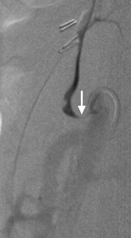 Angiografické vyšetření s průkazem krátké kritické stenózy těsně za odstupem truncus coeliacus. Stenóza průkazná při břišní aortografii (Obr. 2) i selektivní coeliakografii (Obr. 3)
Pic. 2 and 3. Angiography shows short critical stenosis at the origin of celiac trunk. The stenosis is evident in abdominal aortography (Picture 2) and selective celiacography (Picture 3)