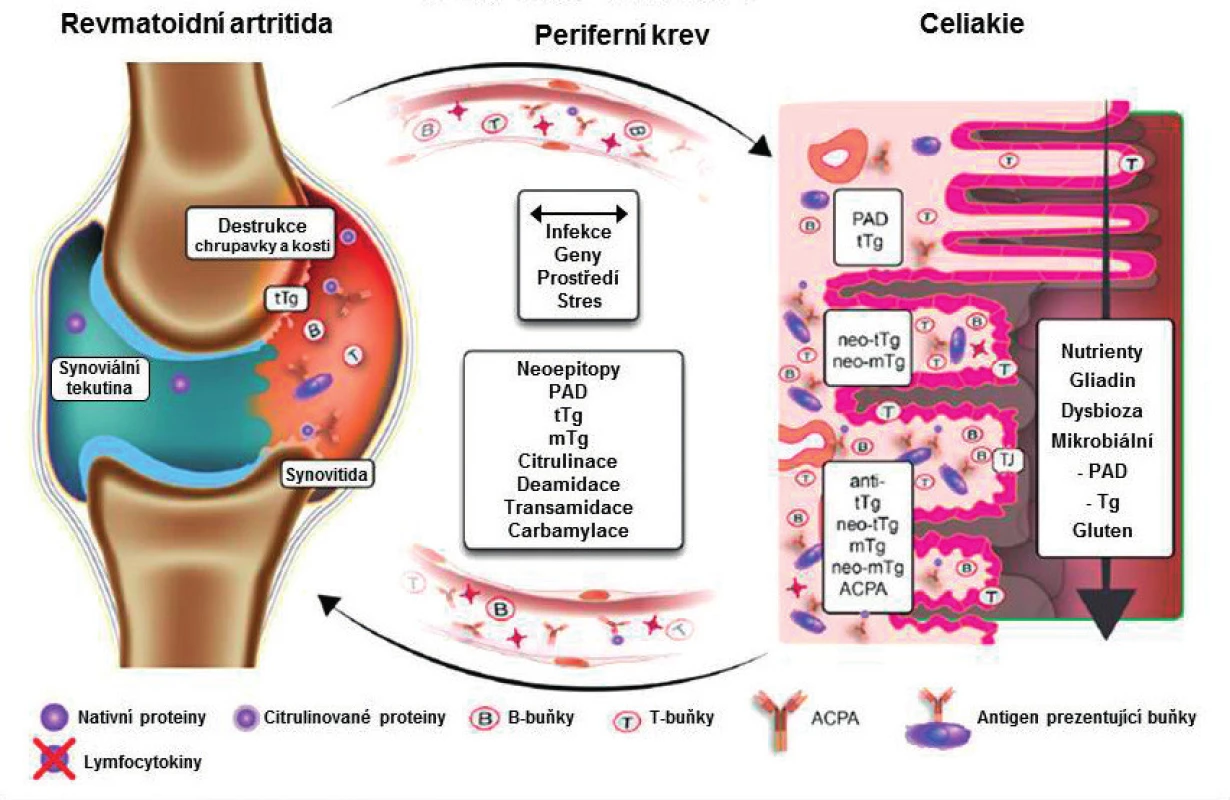 Patogenní dráhy na ose revmatoidní artritida – celiakie.
Upraveno podle A. Lernara a T. Mathiase (12).