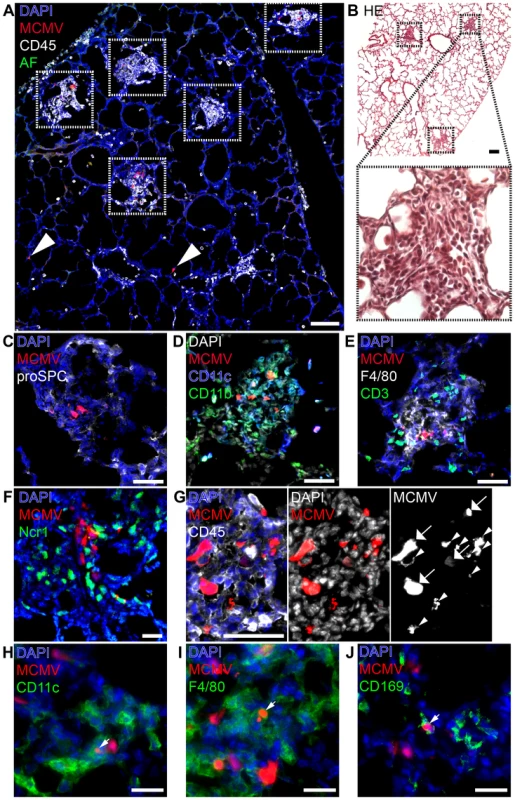 Characterization of “nodular inflammatory foci” in the neonatal lung 5 days after MCMV-3D infection.