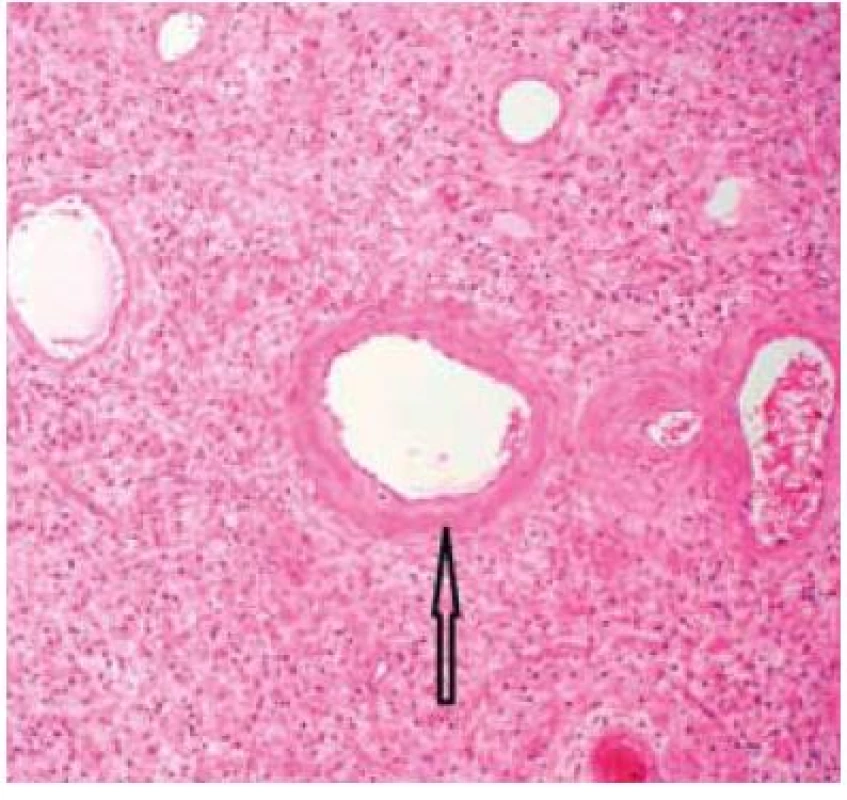 Histologický obraz Vaňkova tumoru s eozinofilním infiltrátem, novotvorbou cév a cibulovitým uspořádáním fibroblastů v jejich okolí (šipka).