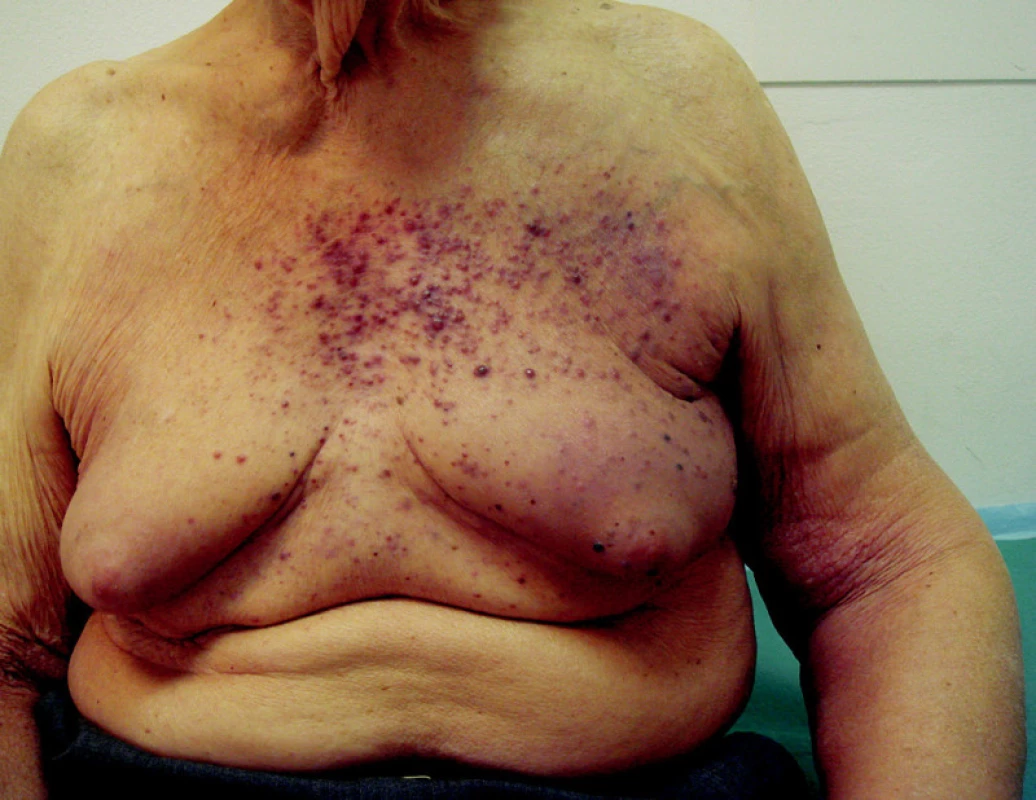 Hematogenní rozsev kožních a podkožních metastáz melanomu bez orgánového postižení