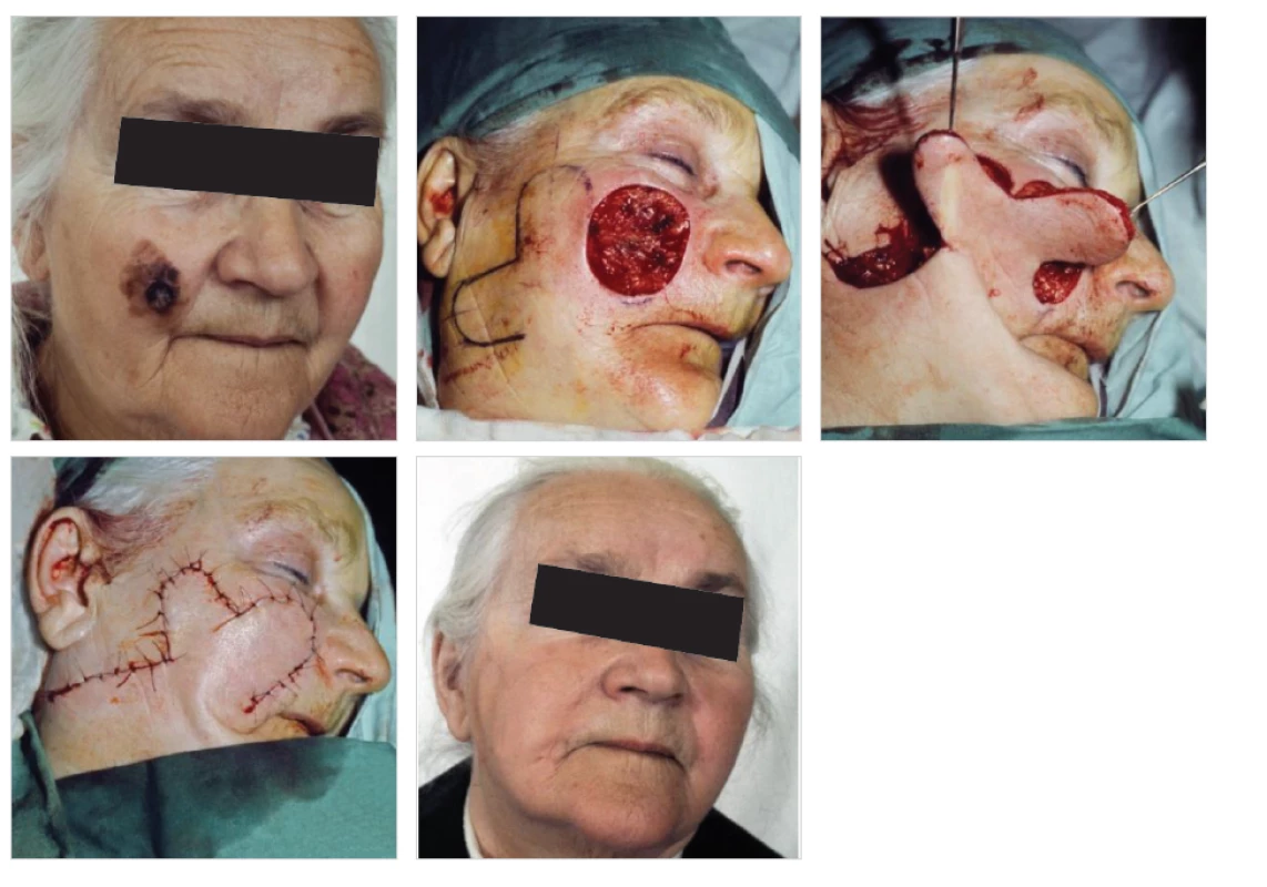 Krytí defektu obličeje dvojitým lalokem po odstranění kožního nádoru
Fig. 1: Coverage of a facial defect with a bilobed flap after removal of a skin tumor