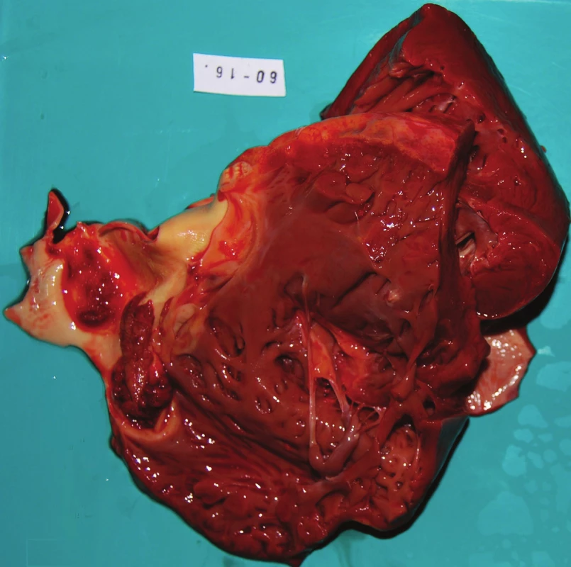 Srdce makroskopicky při pitvě – rozstřižená výtoková část pravé komory; na pulmonální chlopni je patrná polypovitá vegetace.
