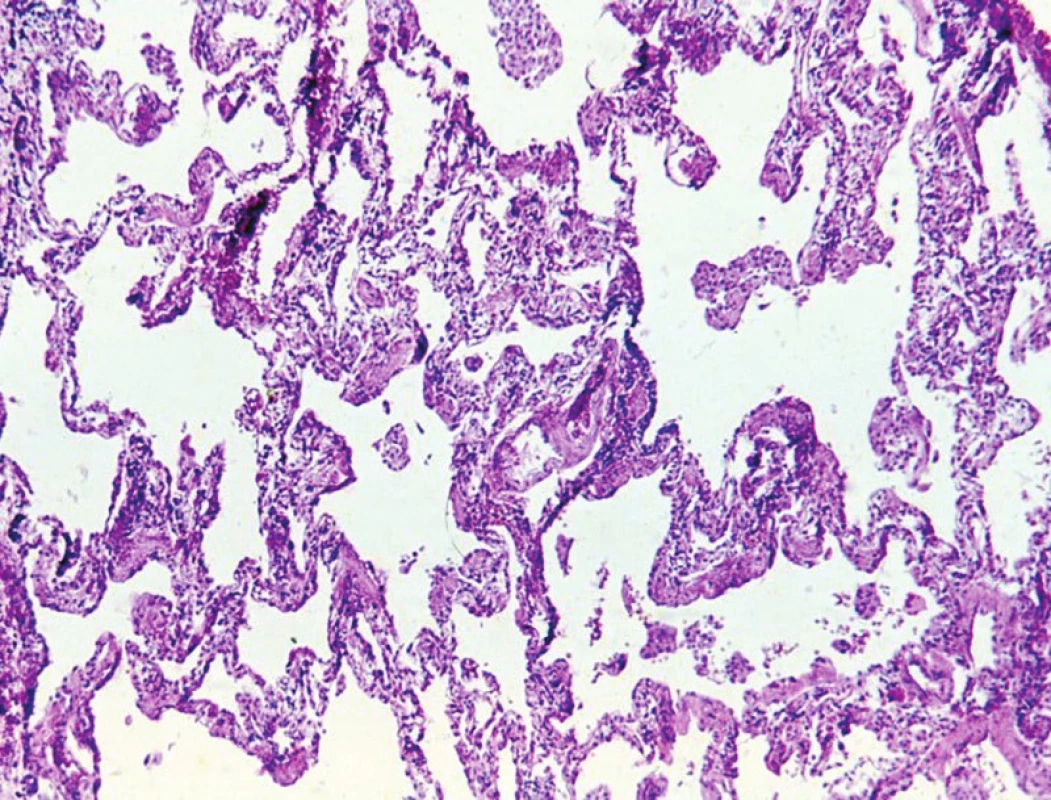 Běžná intersticiální pneumonie. S protilátkou proti cytokeratinům se dobře znázorní pneumocyty vystýlající alveoly. 120krát