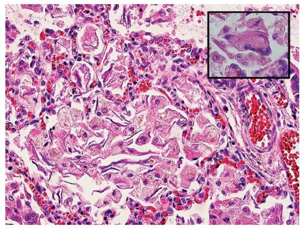 Penovité makrofágy, a miestami aj mnohojadrové obrovské bunky (vložený obrázok) obsahovali intracytoplazmatické inklúzie zlatohnedého a svetloružového sfarbenia. Makrofágy boli PAS-pozitívne, dôkazy železa a žlčových farbív boli negatívne (hematoxylín-eozín, zväčšenie 400x).