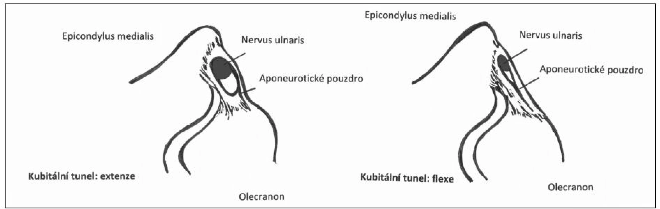 Anatomie kubitálního tunelu ve flexi a extenzi