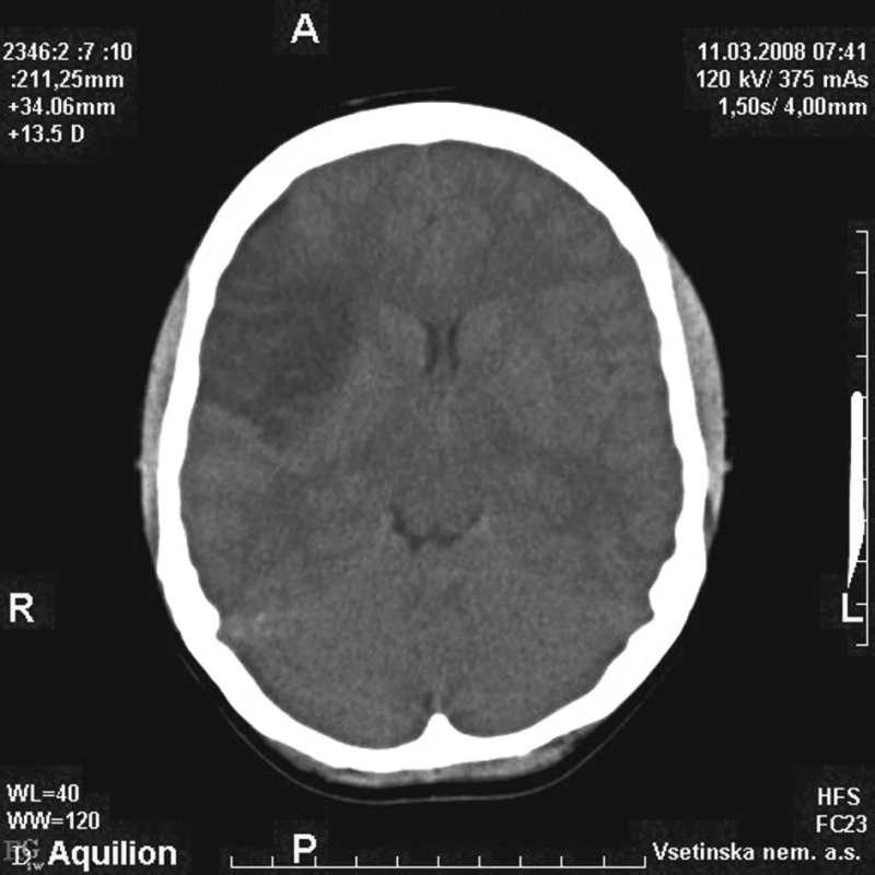 Nativní CT mozku s domnělou kontuzí vpravo 
Fig. 2. Native brain CT images with suspected contusion on the right