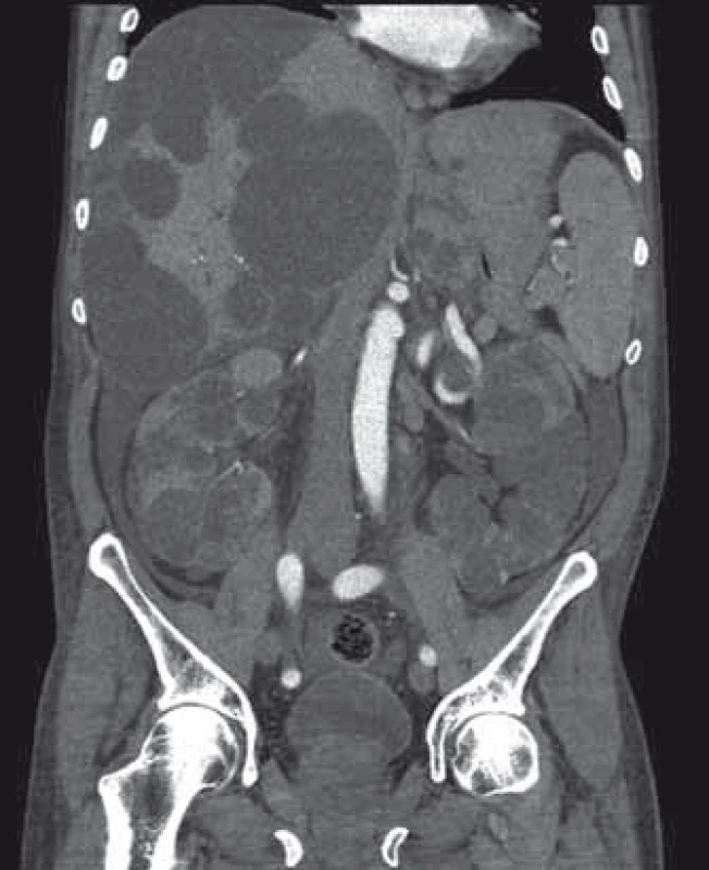Zvětšení jater a ledvin významně změní anatomické poměry v dutině břišní.
Fig. 2. Liver and renal volume expansion signifcantly changes organ topografy of abdominal cavity.