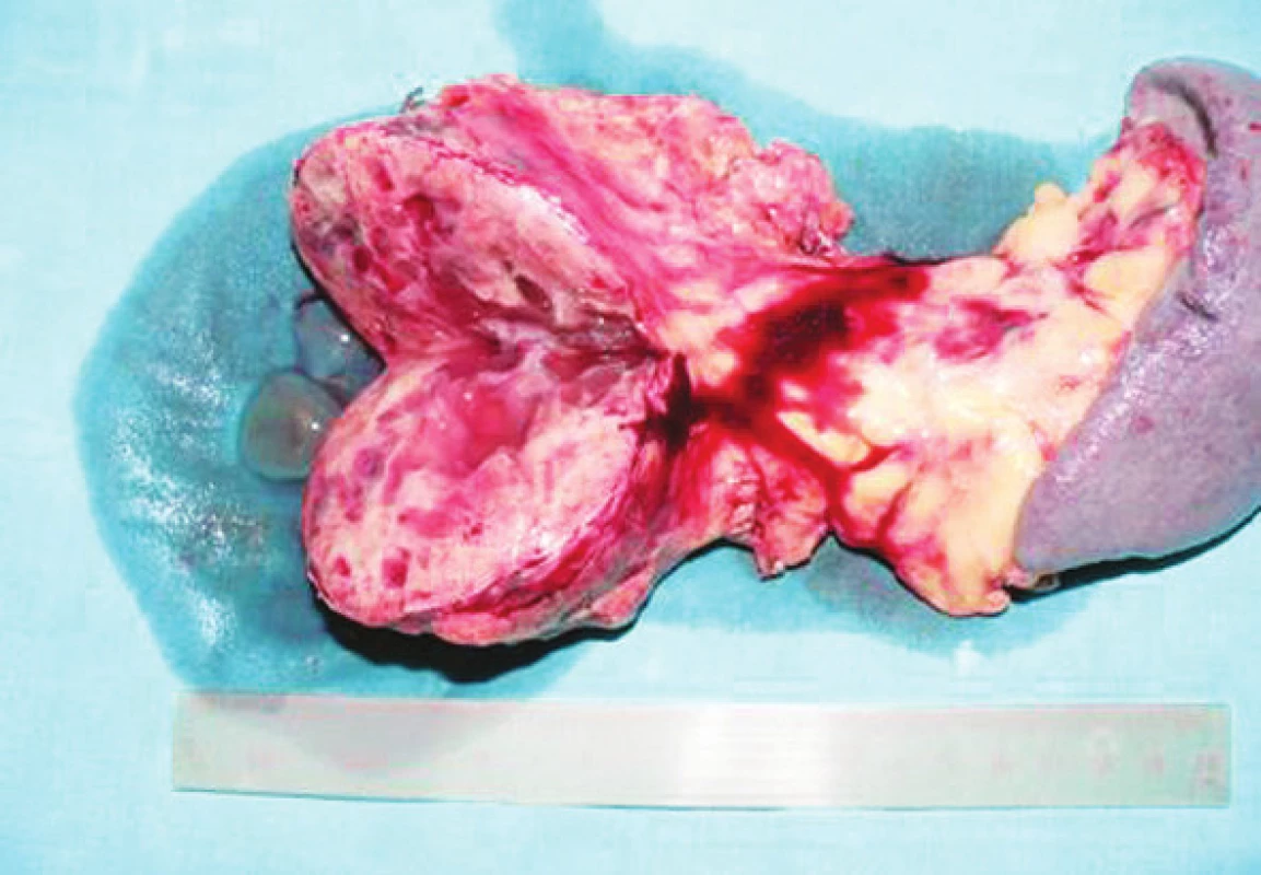 Rozrezaný tumor na dolnej hrane tela pankreasu
Fig. 9. Sliced tumor of the inferior pancreatic body margin