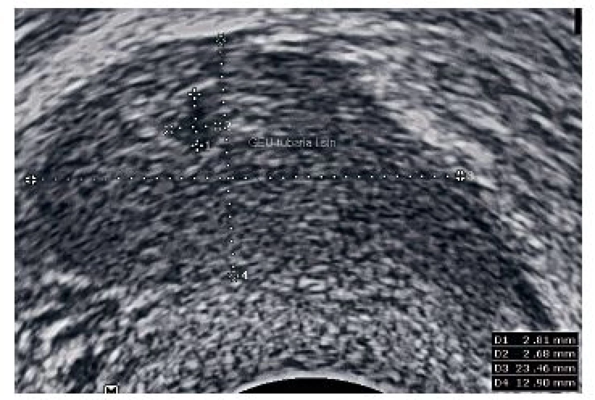 V blízkosti pravého ovaria protáhlá rezistence velikosti 23,46×12,90 mm, uvnitř prázdný gestační váček s hyperechogenním prstencem (bagel sign) – suspektní ektopická gravidita v pravé tubě