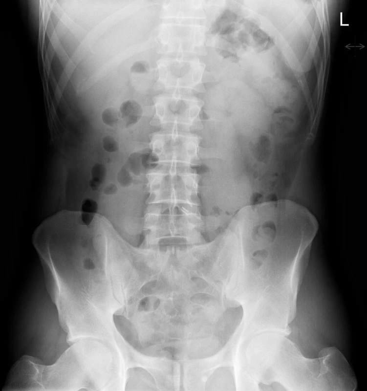 Nativní RTG snímek břicha: normální RTG nález u nemocného s nekomplikovanou akutní divertikulitidou