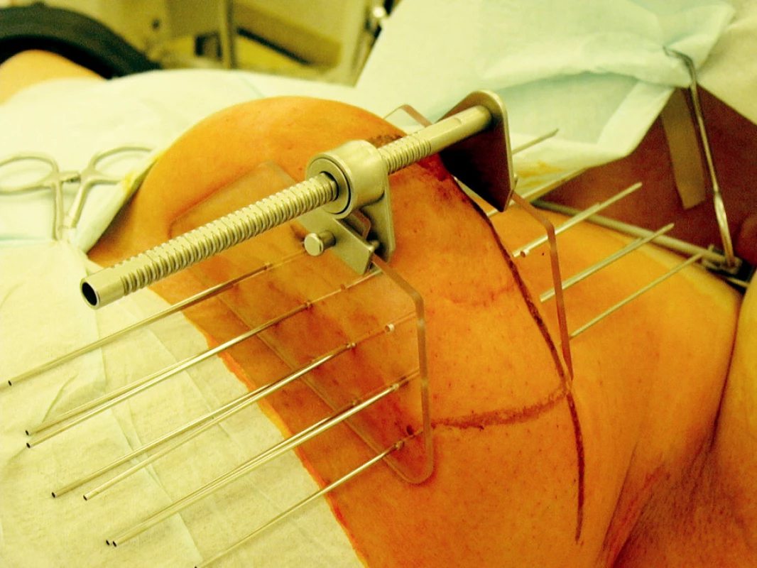 Provedení intersticiální brachyterapie lůžka tumoru po parciální mastektomii pomocí jehel a můstku
Fig. 1. Interstitial brachytherapy procedure of a tumor focus after partial mastectomy, using needles and a bridge