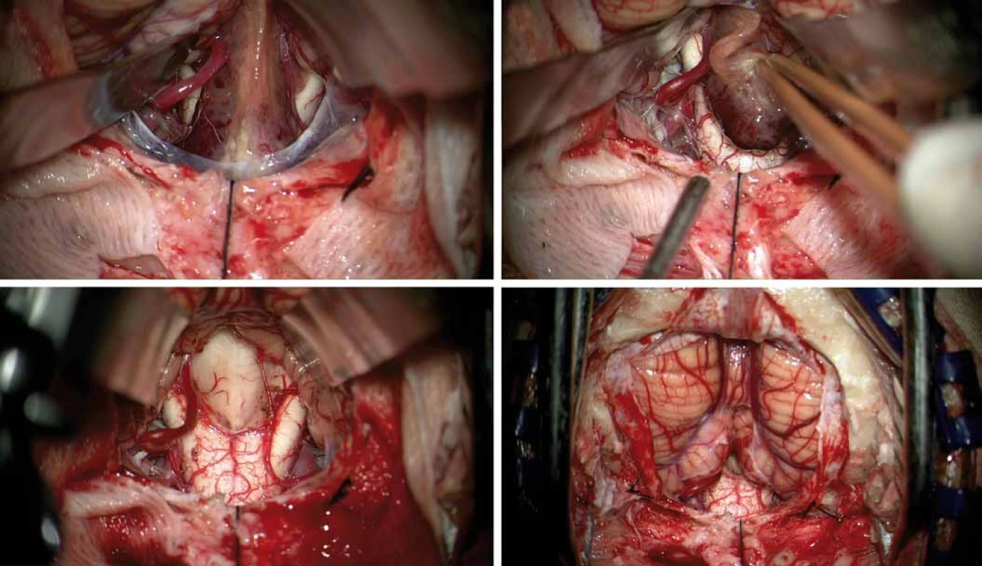 Peroperační mikrofotografie.
Obnažení tumoru mezi nadzdviženými mozečkovými tonzilami, před tumorem prosvítá prodloužená mícha, vlevo je patrná dominantní zadní dolní mozečková tepna (A). Nádorovou masu nesouvisející s míchou bylo možné volně vytáhnout z velkého týlního otvoru (B). Pohled na spodinu IV. komory po radikálním odstranění tumoru s malým lůžkem v oblasti calamus scriptorius (C). Intaktní mozečkové tonzily a prodloužená mícha na konci mikrochirurgické fáze operace (D).