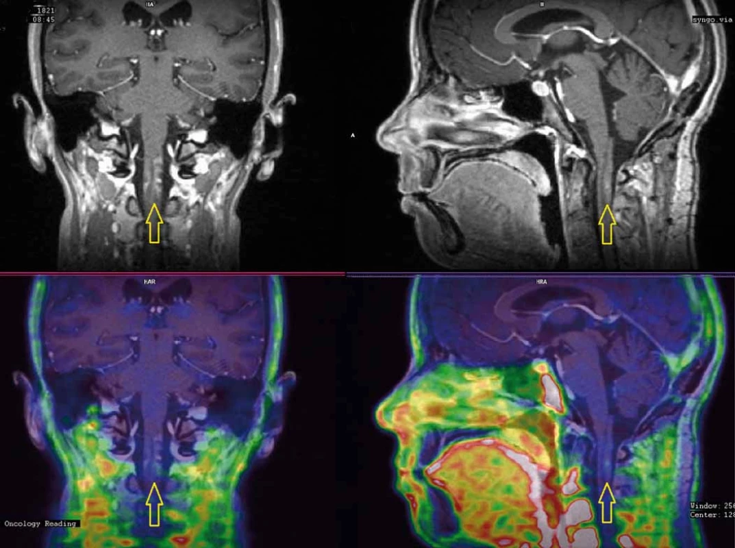 PET/MRI s FLT (fluorothymidin) provedené 18 měsíců po ozáření.
Vyšetření vyloučilo recidivu tumoru a ukázalo obraz regredující radionekrózy (A) s nevelkou akumulací FLT (fluorothymidin) a atrofií míšní (B).