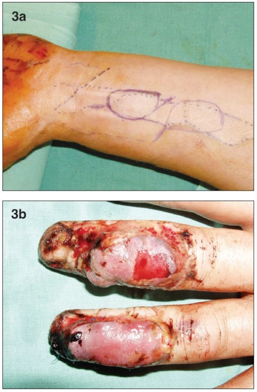 a. Design of both of the free flaps on the distal volar forearm
b. Postoperative swelling and bulae on both flaps on the 3rd day post-op