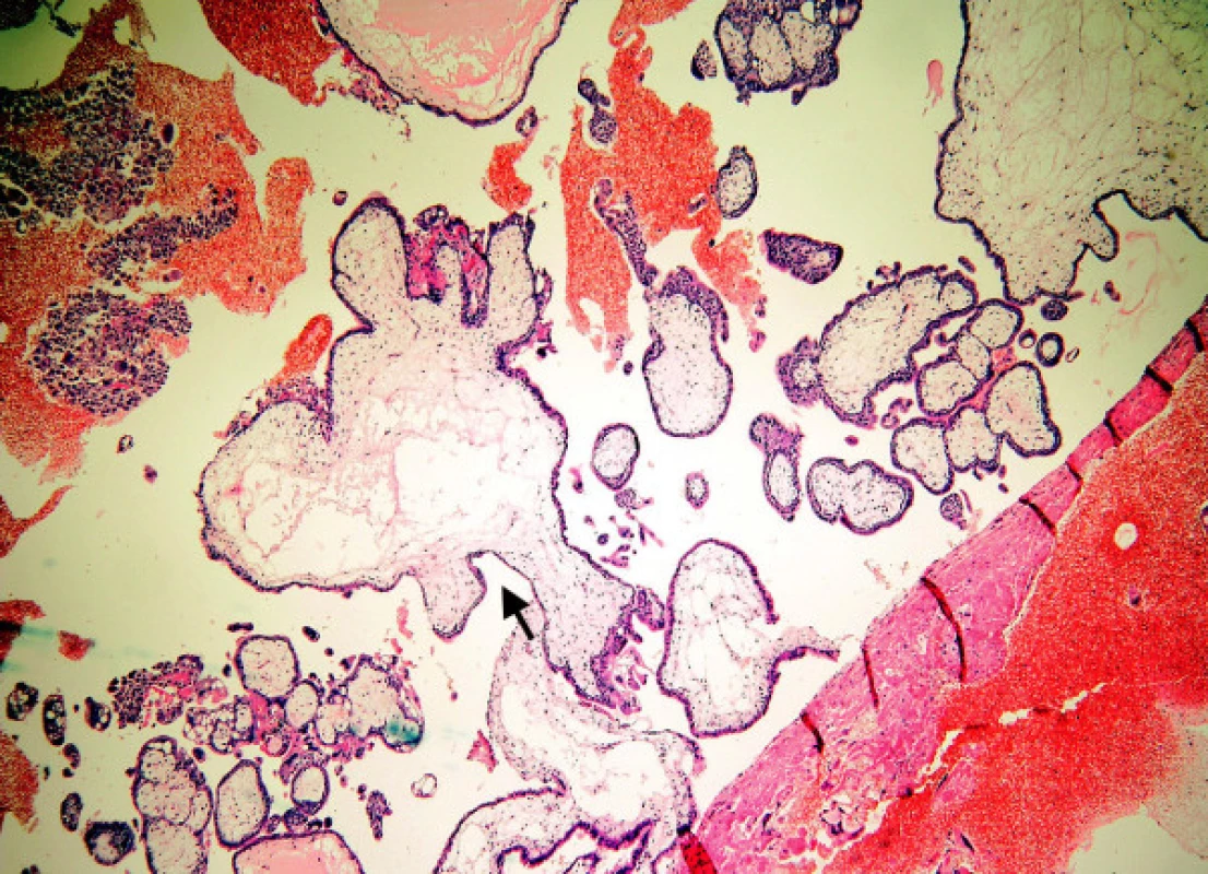 Nezralá mola hydatidosa completa: nepravidelný tvar klků, edém, lehká hyperplazie trofoblastu, mělké široké invaginace (šipka)