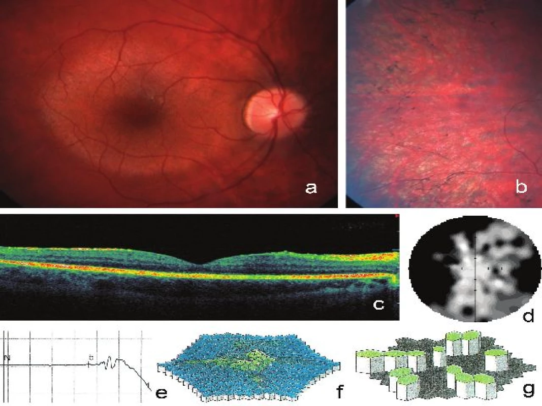 Klinické nálezy zjištěné na pravém oku u 22letého muže (IV:1) s retinitis pigmentosa podmíněnou mutací v ORF15 genu RPGR. Fotografie fundu dokumentuje normální vzhled papily, relativně zachovalá makula s cirkulárním projasněním kontrastuje s chorioretinální atrofií v periférii a). Periferie se shluky pigmentu tvaru kostních buněk b), horizontální sken SD-OCT zobrazující normální makulu a snížení výšky sítnice a cévnatky okolo makuly c), zorné pole s anulárním skotomem d), reziduální tyčinková odpověď e), snížení hustoty odpovědí na trojrozměrném obraze při multifokální ERG f), zbytkové oblasti elektrické aktivity sítnice představované zelenými šestiúhelníky g)