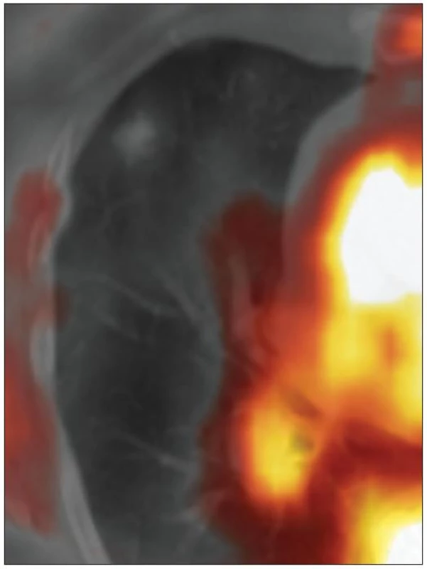 &lt;sup&gt;18&lt;/sup&gt;F-FDG-PET/CT (06/2010). V ložisku není patrna patologická hyperutilizace glukózy.
