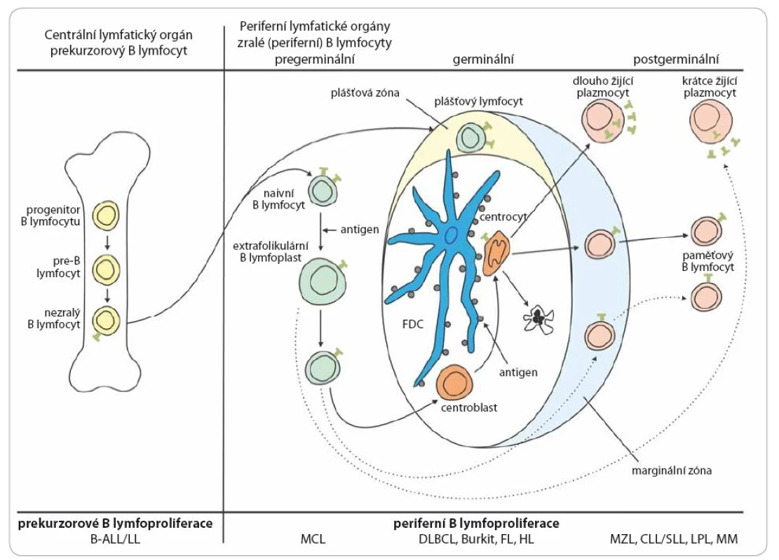 Schéma vývoje B lymfocytu a přehled jednotlivých jednotek B buněčných lymfoproliferativních nádorů.
