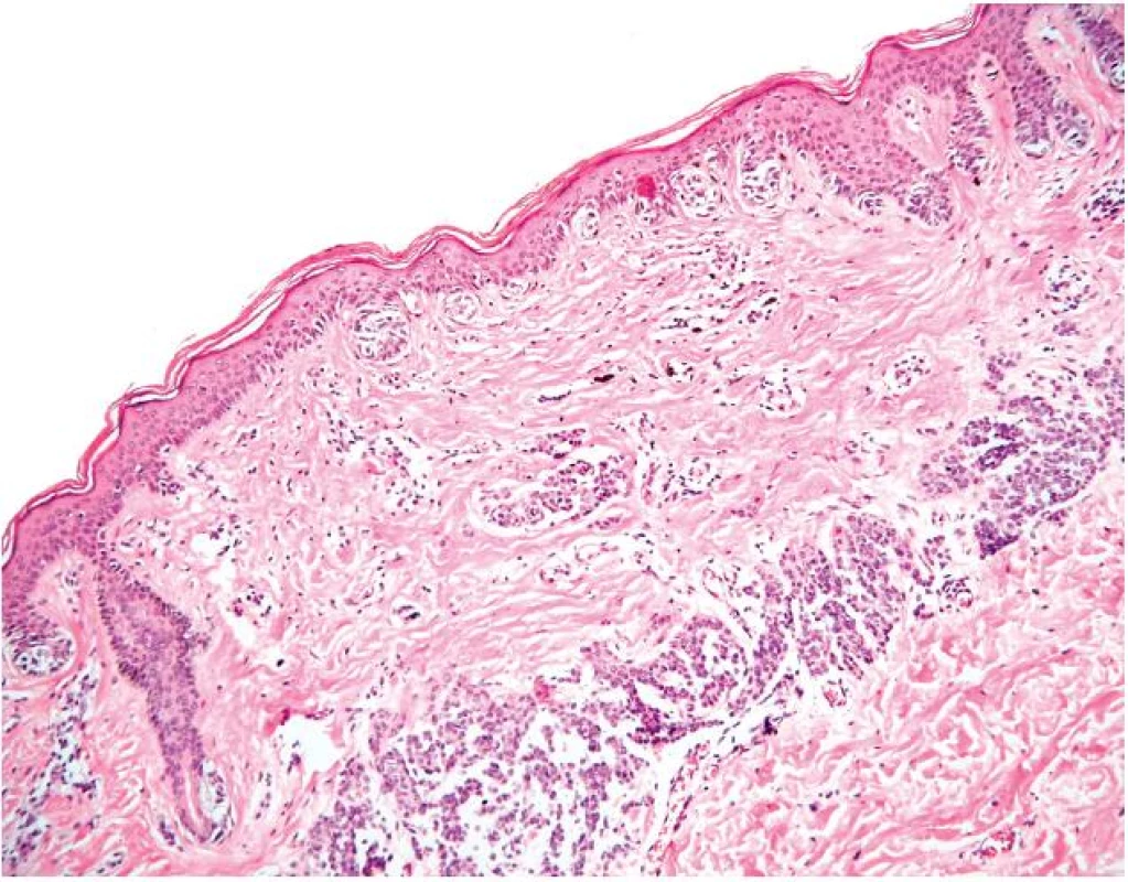 Sklerotizující névus s rysy pseudomelanomu
Architektura je narušena pruhem sklerotizovaného kolagenního vaziva mezi složkou junkční a dermální, v něm je izolované větší hnízdo melanocytů.