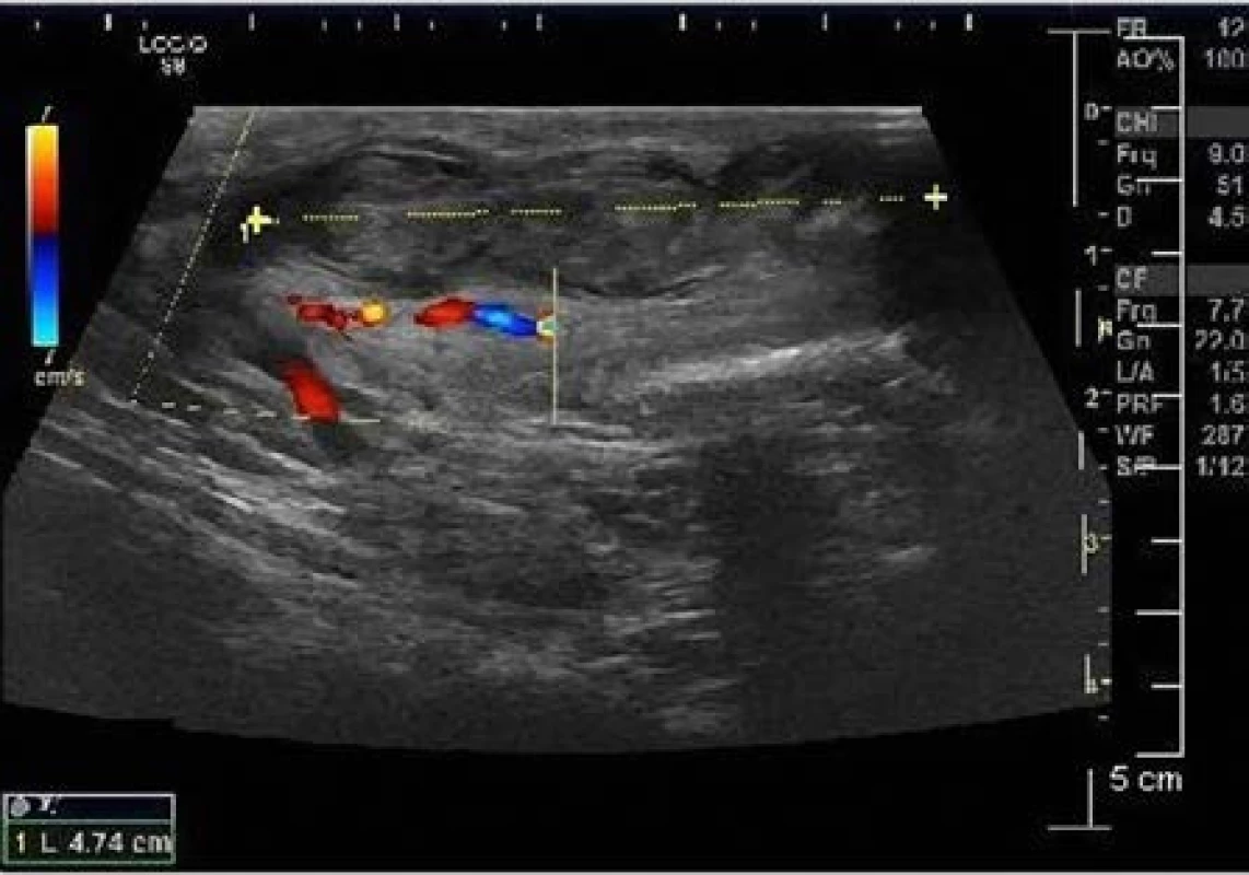 Venózní trombóza v povrchové penilní žíle, bez známek toku v barevném mapování
Fig. 3 Venous thrombosis of the superficial penile vein, without flow seen on color Doppler imaging