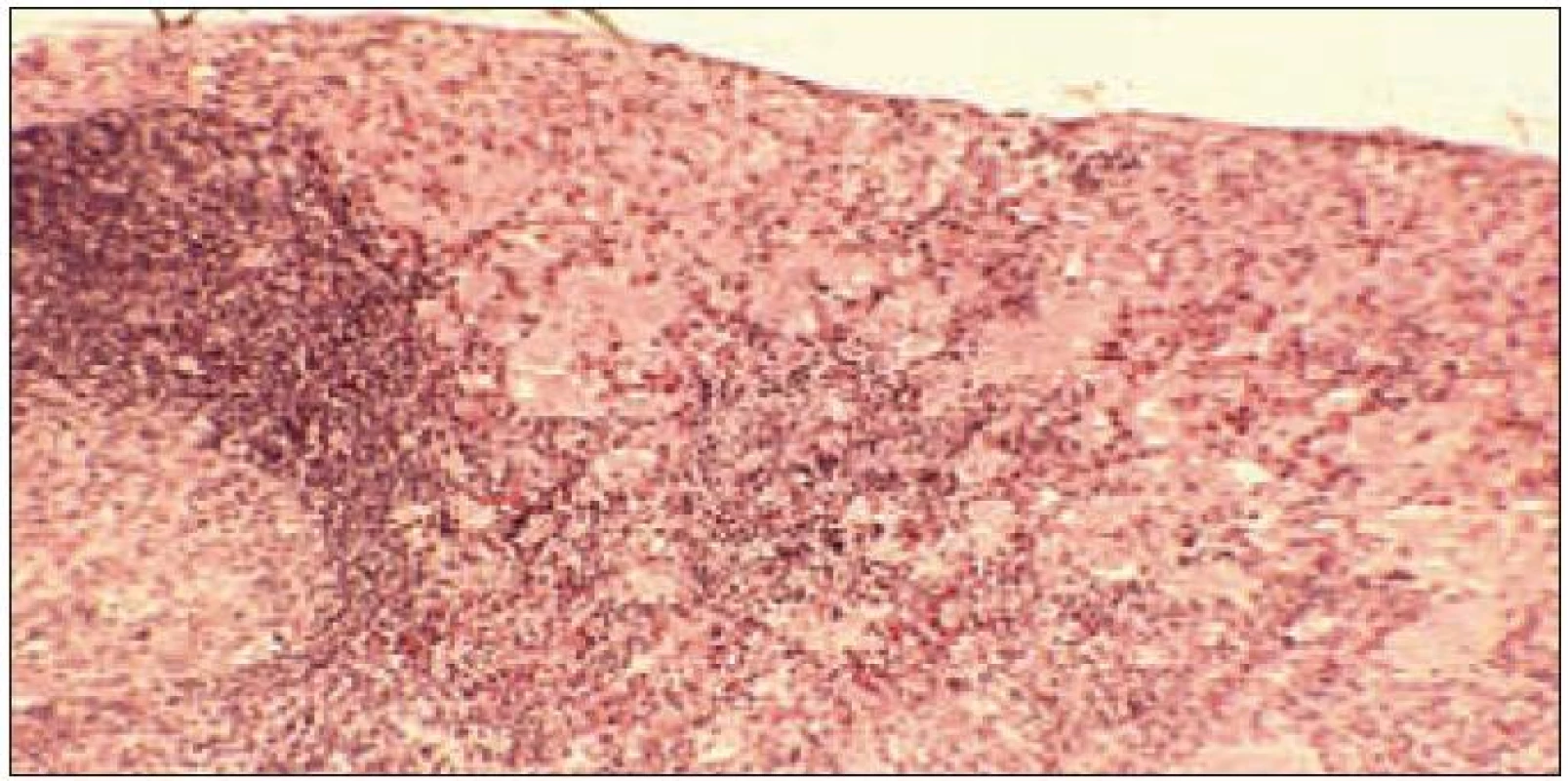 Lymfatická uzlina se zachycenou korou a částí zárodečného centra lymfatického folikulu (vlevo) je v periferním splavu a v koře infiltrována souvislou monomorfní infiltrací Langerhansovými histiocyty při geneneralizované multiorgánové formě LCH.