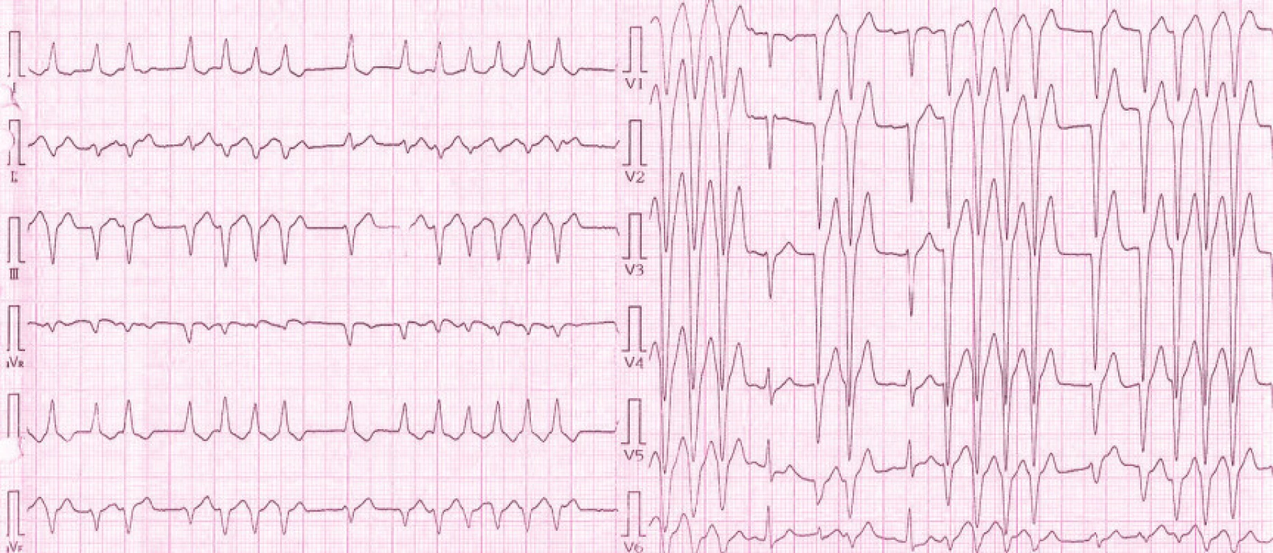 EKG pacientky při přijetí na Interní kardiologickou kliniku: na záznamu přítomny pouze 2 sinusové komplexy (PQ 0,14 ms, QRS 0,10 ms), převažují salvy monomorfních extrasystol se širokým QRS komplexem (QRS 120 ms) s inferiorní osou a negativní konkordancí v hrudních svodech, což s největší pravděpodobností svědčí o komorovém původu extrasystol.