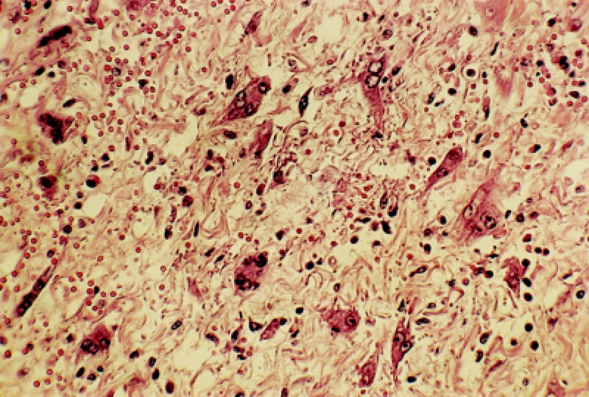 Reaktivně změněné fibroblasty ve slizničním vazivu (barvení HE, zvětšení 80×)