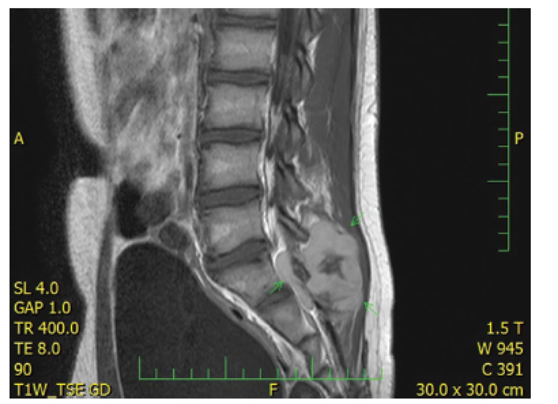 Kazuistika &lt;b&gt;2&lt;/b&gt;. Objemná expanze v měkkých tkáních dorzálně za křížovou kostí v úrovni L5 až S3 s propagací do páteřního kanálu (MRI).